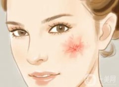 紅血絲去除手術(shù)要多少錢？