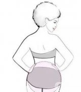 埋線減肥有嗎？有什么果？