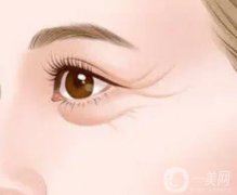 魚尾紋注射玻尿酸有用嗎？魚尾紋注射玻尿酸嗎？