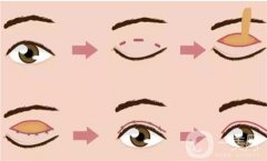 做雙眼皮后恢復(fù)自然需要多長時(shí)間？術(shù)前有哪些禁忌？