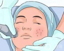 對祛痘印做彩光嫩膚有嗎？