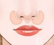 玻尿酸填充鼻唇溝的原理是什么?