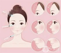 淚溝填充自體脂肪可以維持多久？