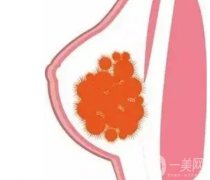 奧美定是什么？取出后的殘留物取會(huì)致癌嗎