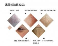 果酸換膚調(diào)節(jié)的間隔時間是多久？