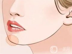 注射玻尿酸豐下巴后需要注意什么？