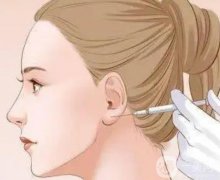 玻尿酸豐耳垂能維持多久？