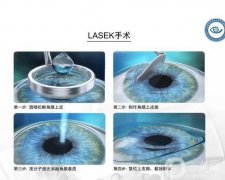 準(zhǔn)分子激光手術(shù)價(jià)格多少錢(qián)？