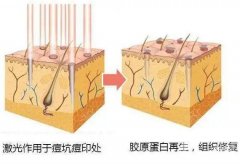 做激光點(diǎn)陣疼嗎，可以用麻藥嗎？