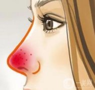 酒渣鼻怎么調(diào)節(jié)？病因是什么？