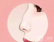 駝峰鼻的分類及矯正方法?