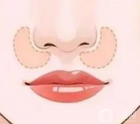 鼻唇溝填充的手術(shù)方法及注意事項