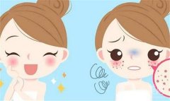 激光祛斑有哪些優(yōu)勢？