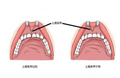 唇系帶整形手術(shù)的方法和步驟？