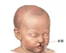 胎兒唇裂的原因及修復方法？