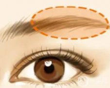 有哪些常見的眉弓整形方法？