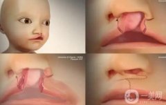 唇腭裂修復(fù)術(shù)后的護(hù)理