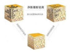 鐳射凈膚有什么果？做一次要多少錢？