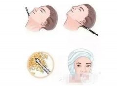 面部抽脂后皮膚會(huì)松弛嗎？果是*的嗎？