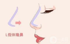 膨體隆鼻的副作用有哪些？需要多長(zhǎng)的時(shí)間才會(huì)恢復(fù)？