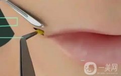 什么是嘴角上揚手術？不適合哪些人