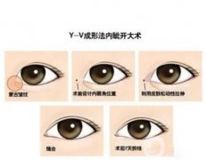 手術設計與開內(nèi)眼角的果有關系嗎？