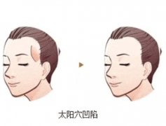 太陽穴凹陷應該怎么辦？太陽穴凹陷有什么特點？