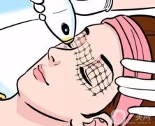 做熱瑪吉可以去除法令紋嗎?