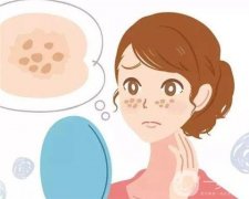 激光去痘印后如何處理抗黑？激光祛痘后的防黑是失敗的嗎？