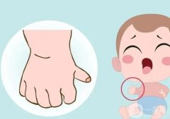 手指畸形有哪些類型？