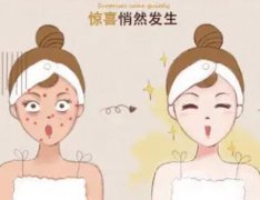 做激光后的注意事項(xiàng)有哪些呢？