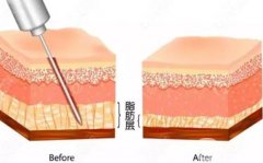 水動(dòng)力吸脂價(jià)格的影響因素有哪些？有什么副作用？