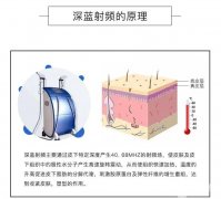 深藍(lán)射頻除皺有什么優(yōu)點(diǎn)？哪些因素決定深藍(lán)射頻除皺的價(jià)格