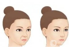 哪些因素影響玻尿酸填充法令紋的價(jià)格？法令紋填充后需要注意什么？