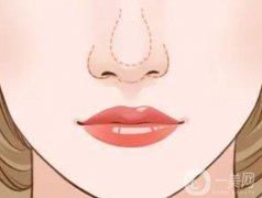 什么樣的假體墊鼻尖會(huì)穿透鼻尖？有哪些注意事項(xiàng)？