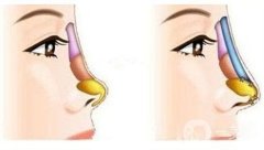 鞍鼻整形貴嗎，價(jià)格是多少?