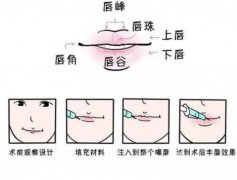 玻尿酸豐唇的優(yōu)點(diǎn)是什么，果如何？
