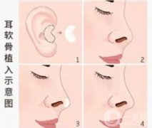 耳軟骨墊鼻尖有什么副作用和后遺癥？