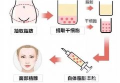 如何處理自體脂肪填充后的硬結？有什么風險？