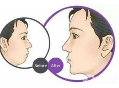 墊下巴后什么時(shí)候可以吃東西？墊下巴后要腫多長時(shí)間？