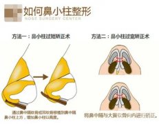 玻尿酸可以注射鼻小柱嗎？鼻小柱延長有哪些常用方法