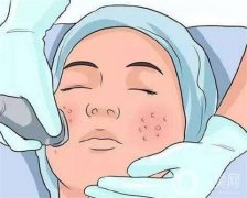 彩光嫩膚可以去除痘印嗎？如何護(hù)理？