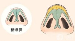 鼻頭縮小手術(shù)的優(yōu)點(diǎn)和缺點(diǎn)是什么？