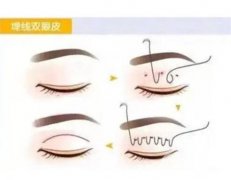 埋線雙眼皮能重做嗎？埋線雙眼皮的價格是多少？