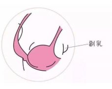 不切除副乳可以嗎？副乳可以不做手術(shù)嗎？