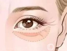 眼袋去除手術(shù)后會(huì)不會(huì)留下疤痕？手術(shù)痛不痛？