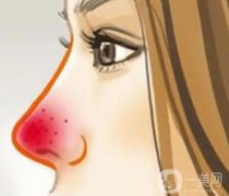 引起酒渣鼻的原因是什么？需要多少錢？