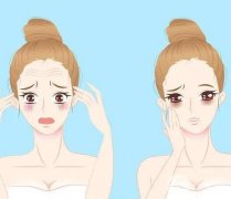 填充法令紋可以用哪些玻尿酸？