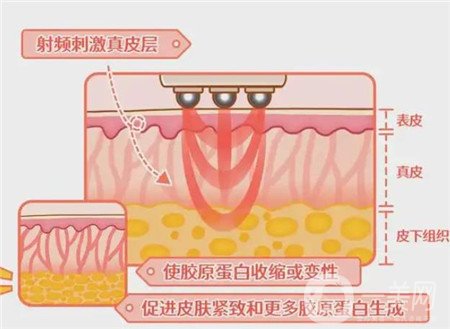 熱瑪吉電波拉皮*果怎么樣？維持多久？