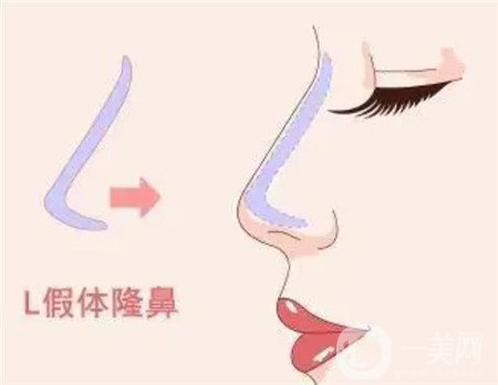 鼻頭縮小手術(shù)圖,鼻頭縮小注意事項